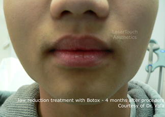 jaw reduction with Botox results brooklyn